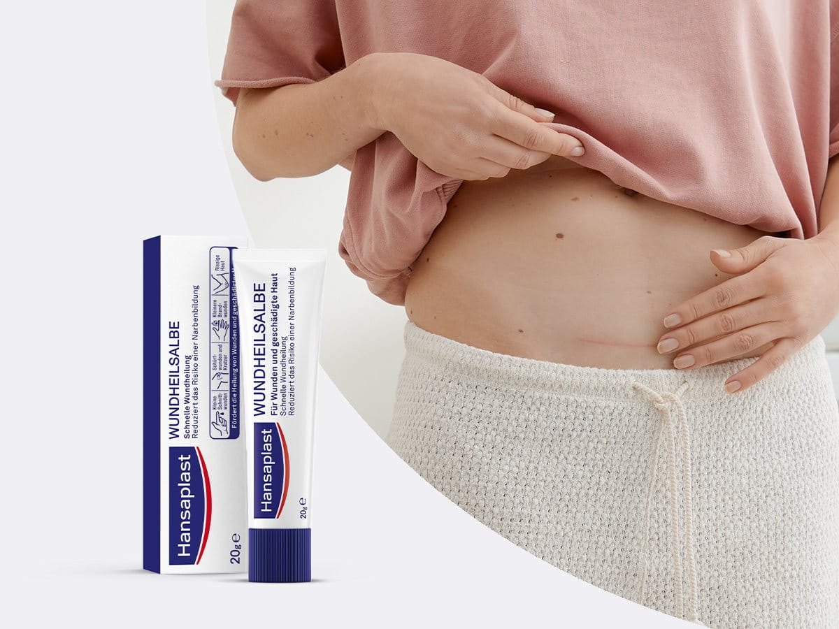Produktbild der Hansaplast Wundheilsalbe und Nahaufnahme eines Unterbauchs mit verheilter Narbe.