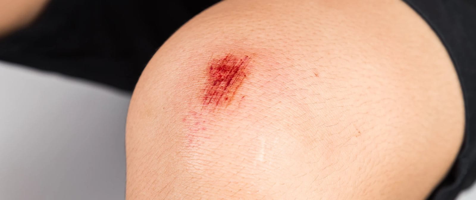 Pertolongan pertama pada luka gores yang perlu diketahui.