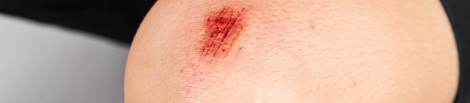 Pertolongan pertama pada luka gores yang perlu diketahui.