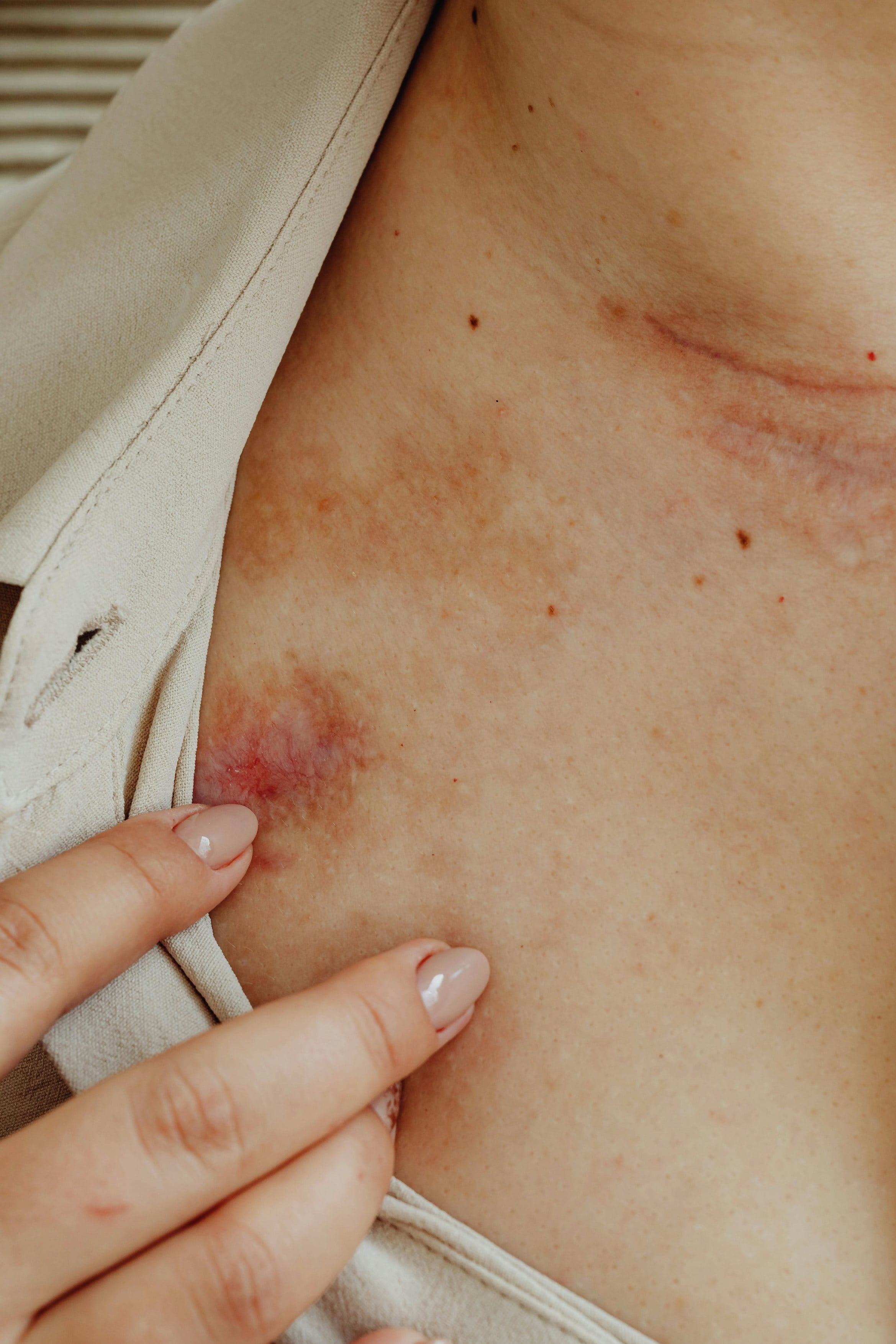 a small dark and blue bruise in someone's shoulder