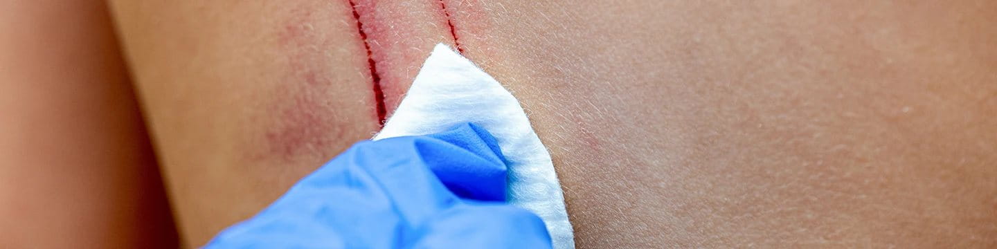Effective Wound Care Tips