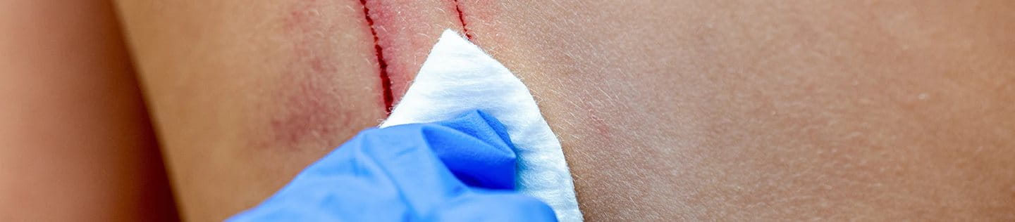 Effective Wound Care Tips