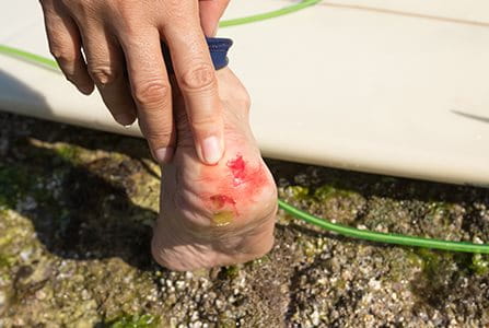 Cómo proteger herida del agua