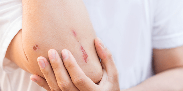 Aufgeschürfter Ellenbogen