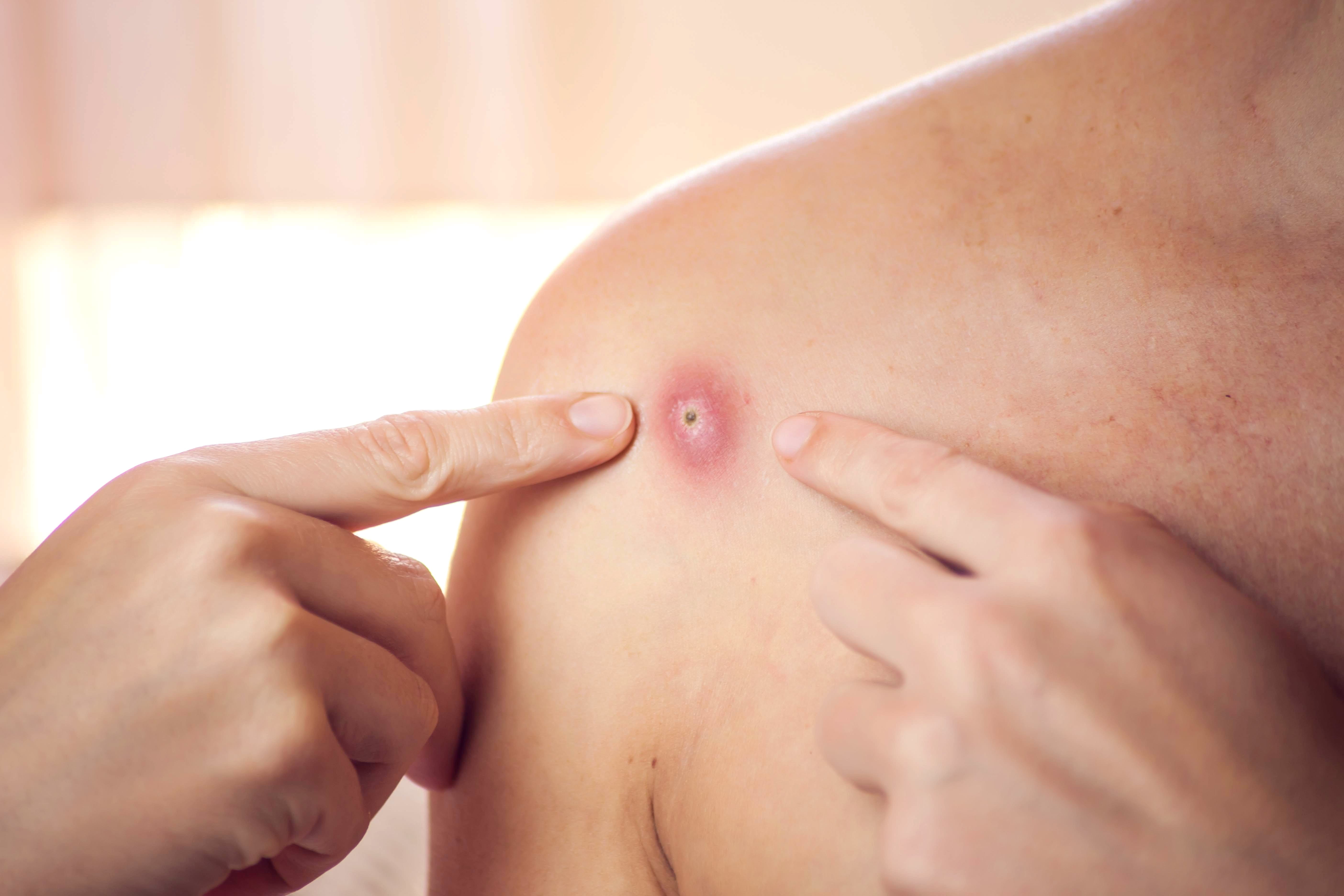 Nahaufnahme einer entzündeten Hautstelle mit eitrigem Furunkel auf der Schulter, auf die zwei Finger zeigen.