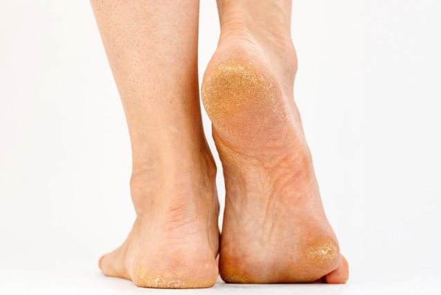 Problemas comunes de los pies