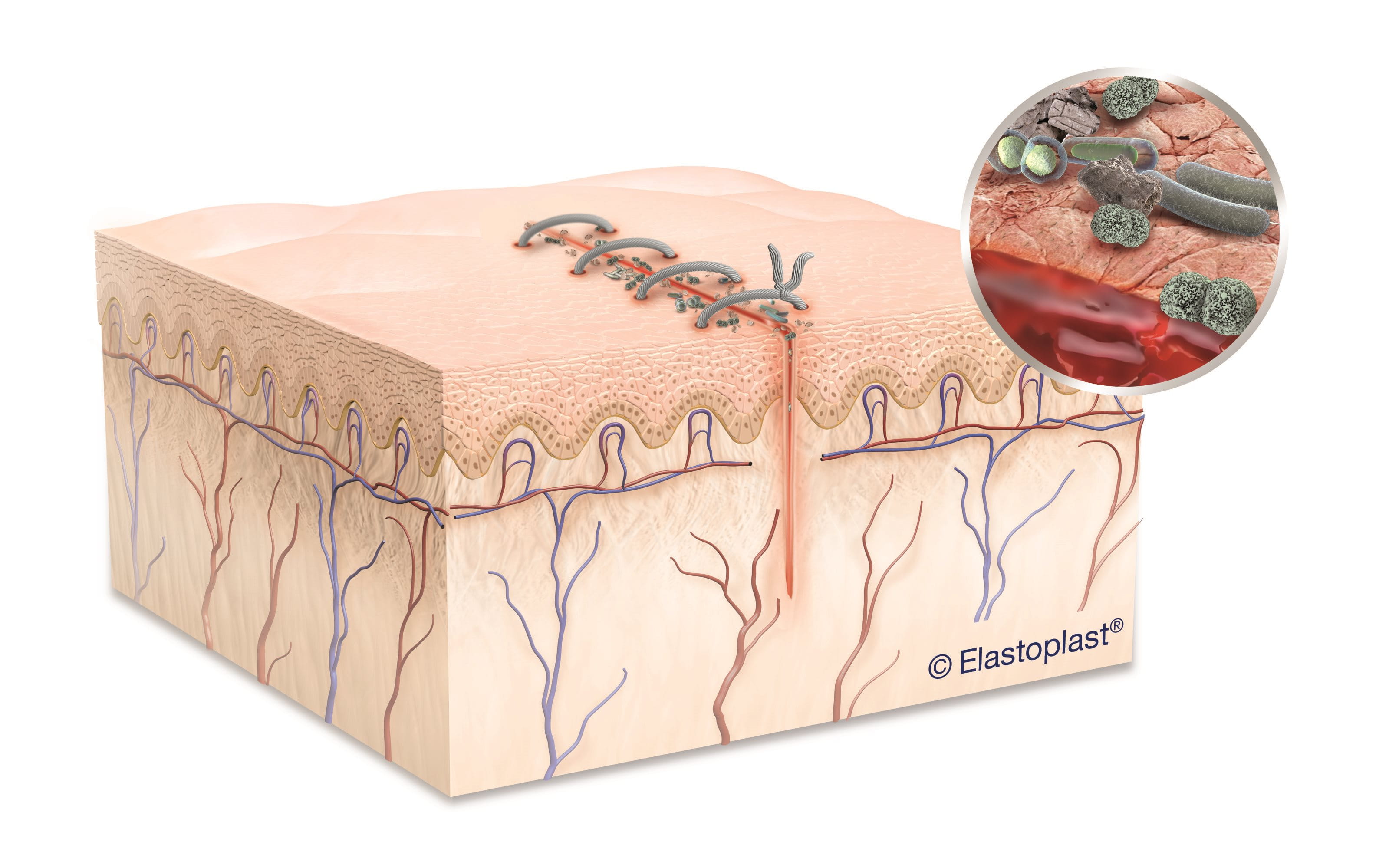 Image of a diagram showing bacterial growth on surgical stitches