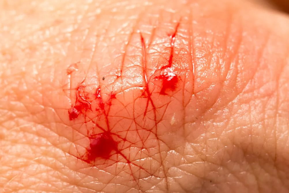 Cara mengatasi luka infeksi dengan baik