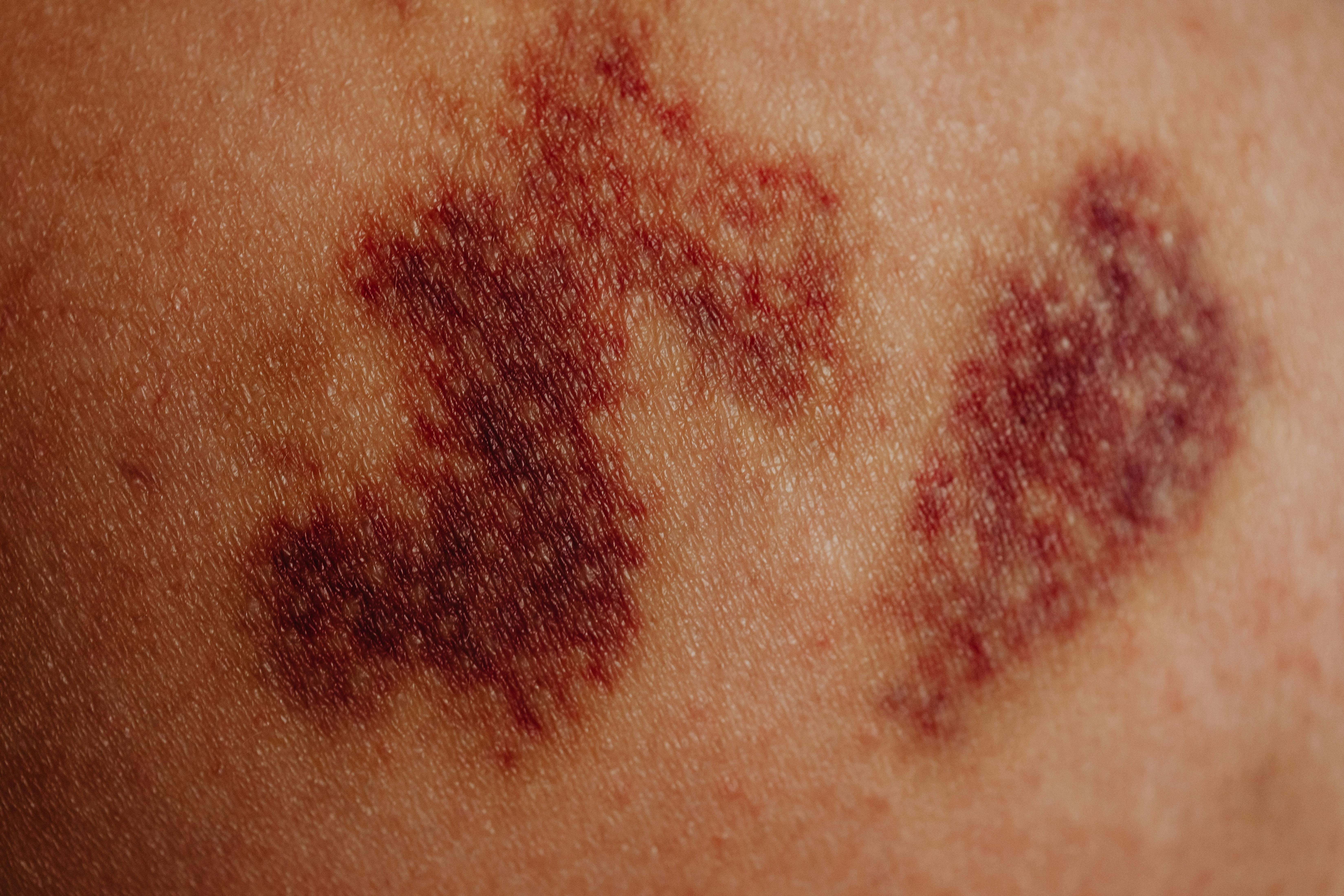 A visual of dark purple small bruises because of a minor injury