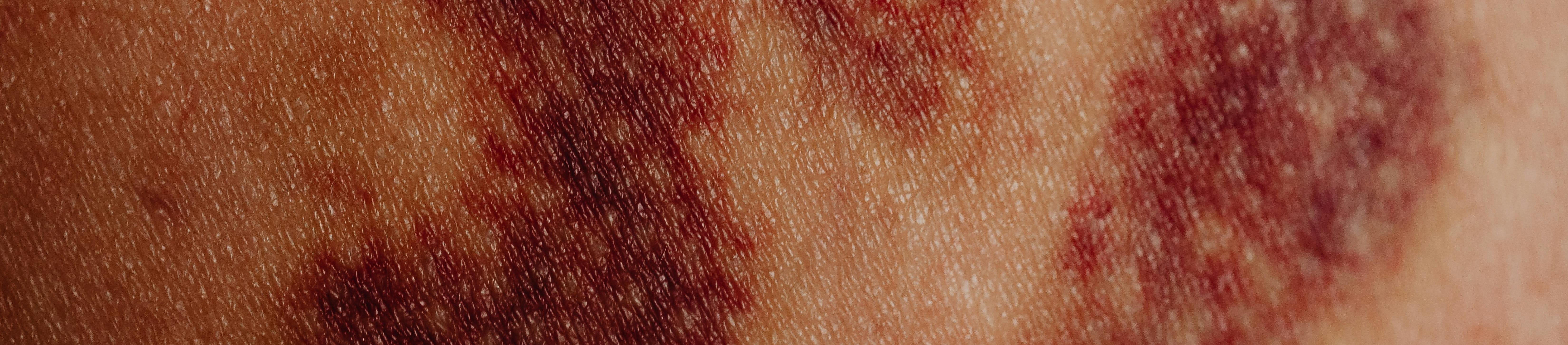 a close up look of bruises on the body