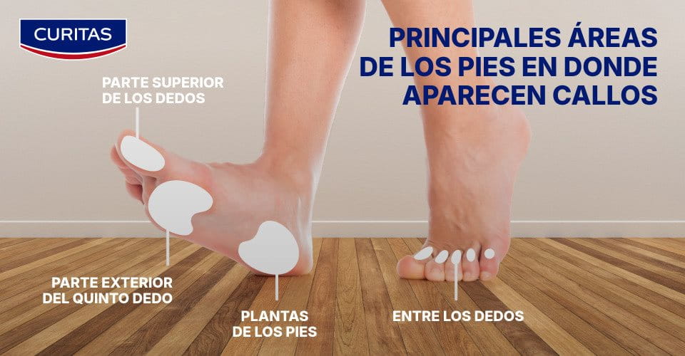 Zonas de los pies con callos
