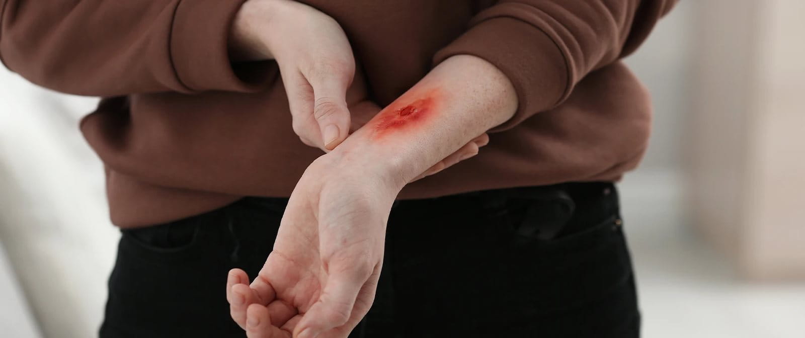 Langkah penanganan luka bakar yang tepat.