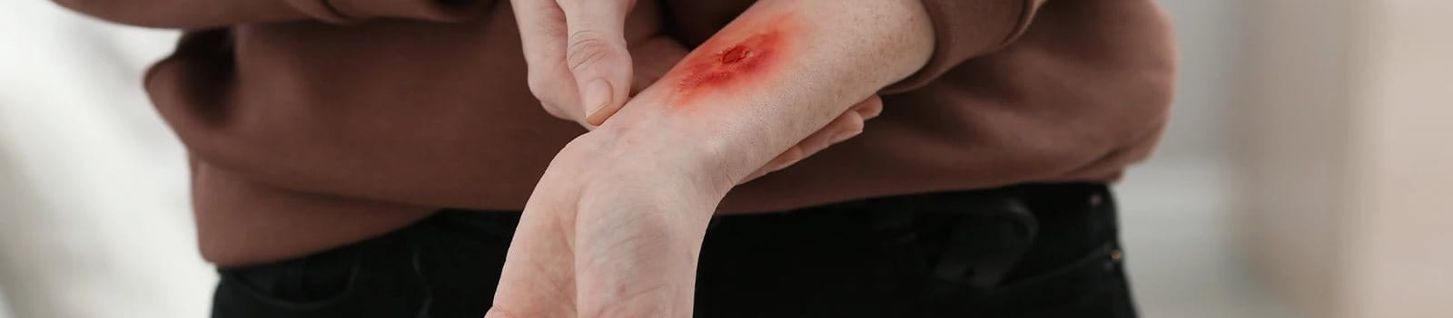 Langkah penanganan luka bakar yang tepat.