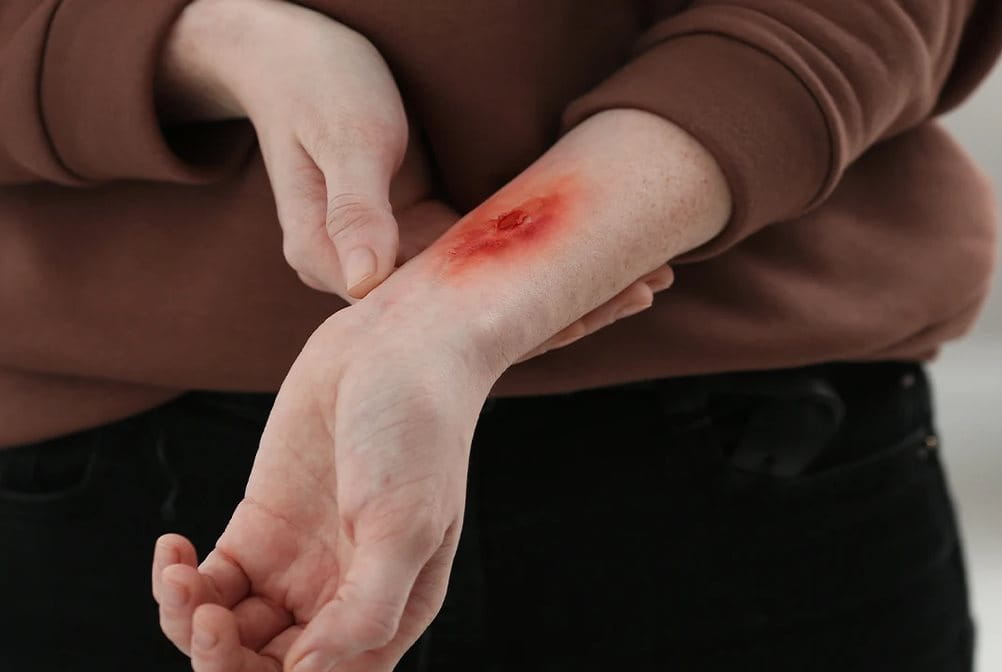 Langkah penanganan luka bakar yang tepat.