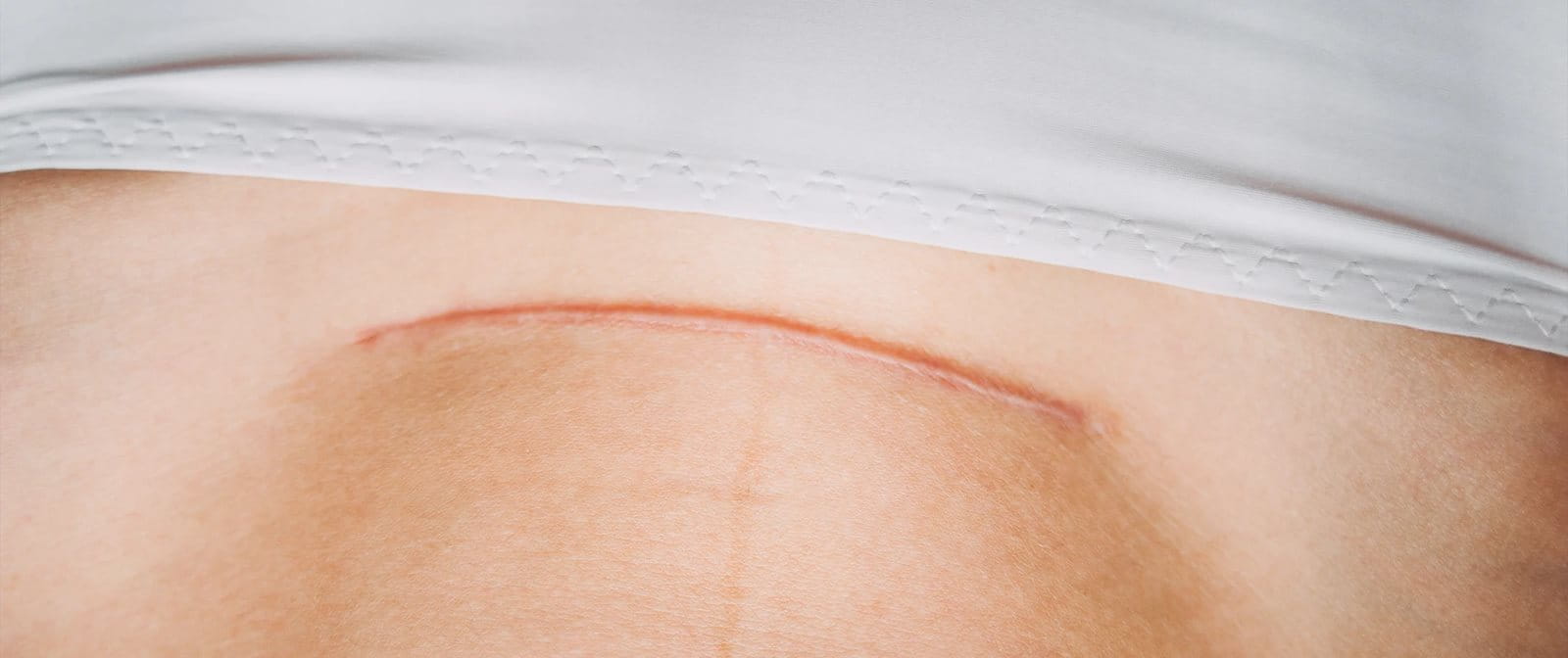 Bekas luka pada kulit pasca operasi