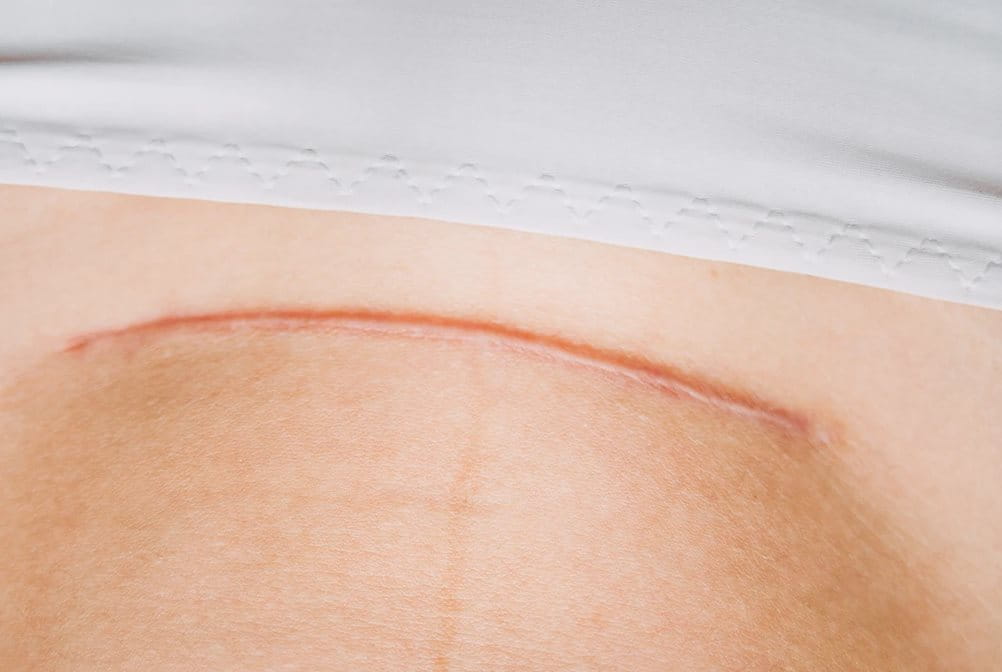 Bekas luka pada kulit pasca operasi