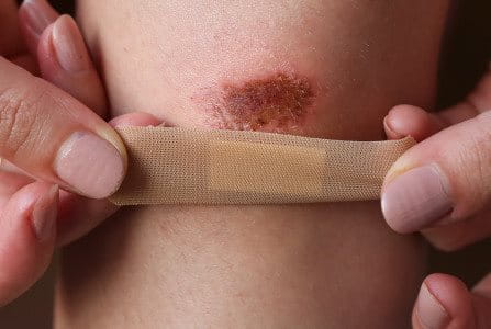 Heridas menores en la piel