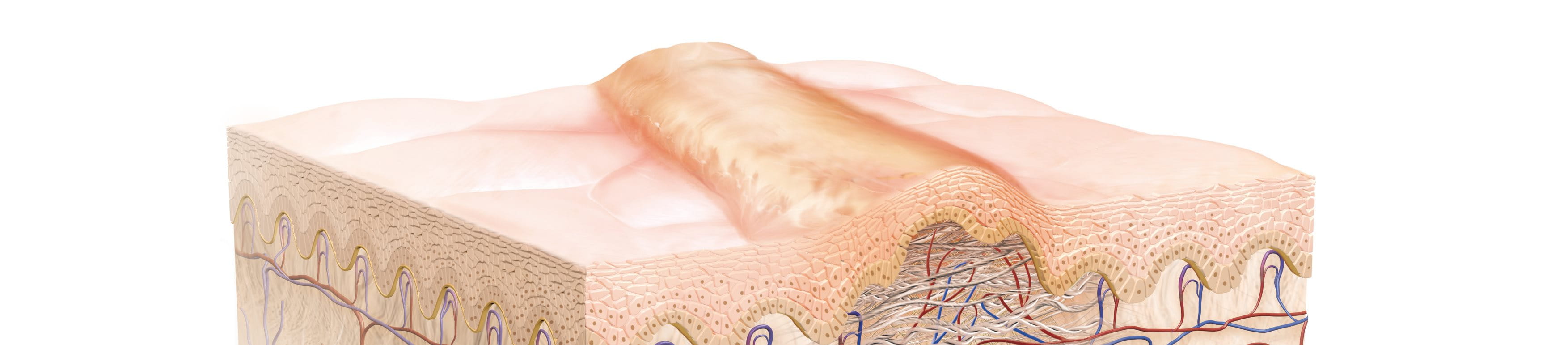 diagram of a hypertrophic scar