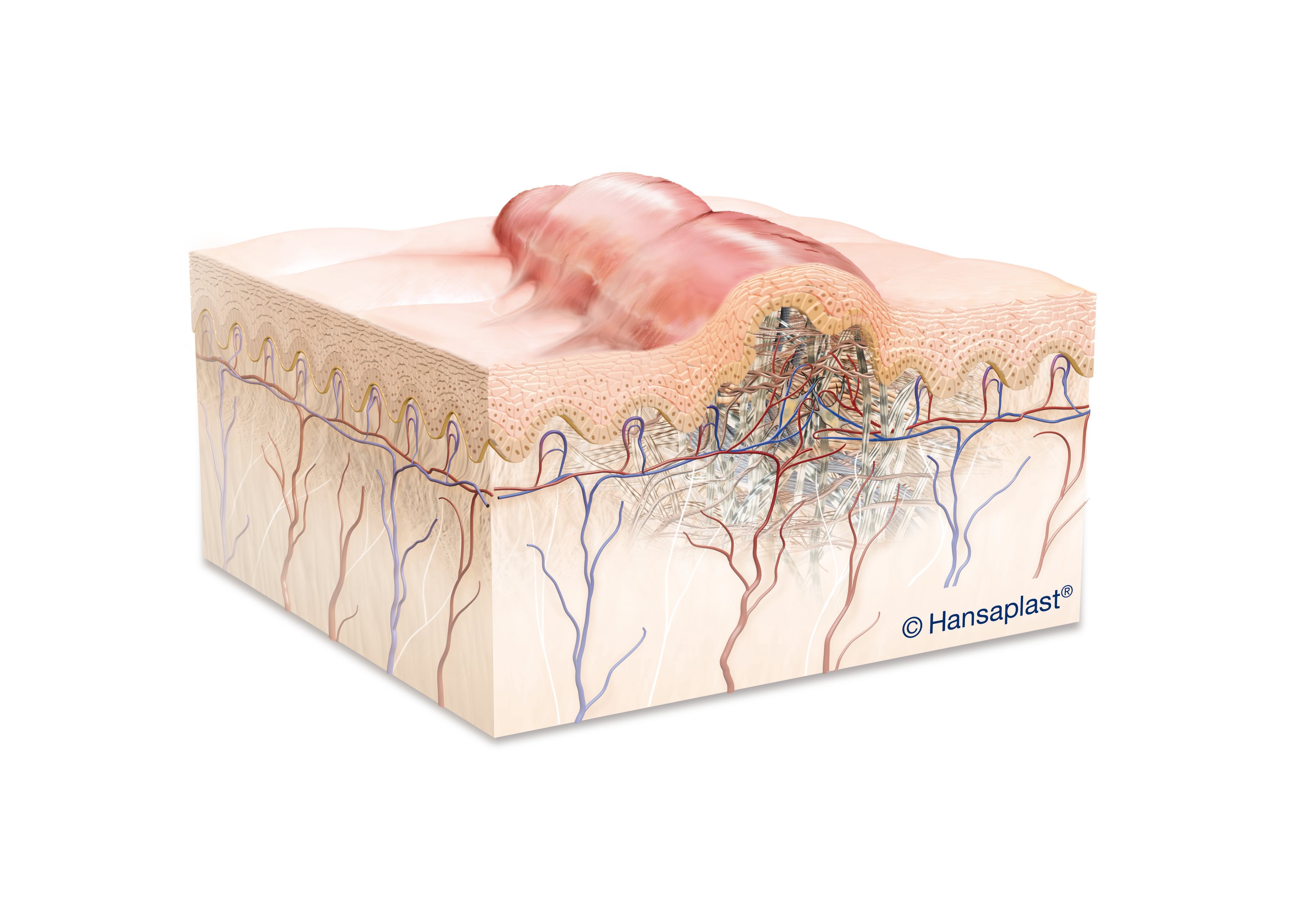 Illustrazione scientifica di una cicatrice ipertrofica