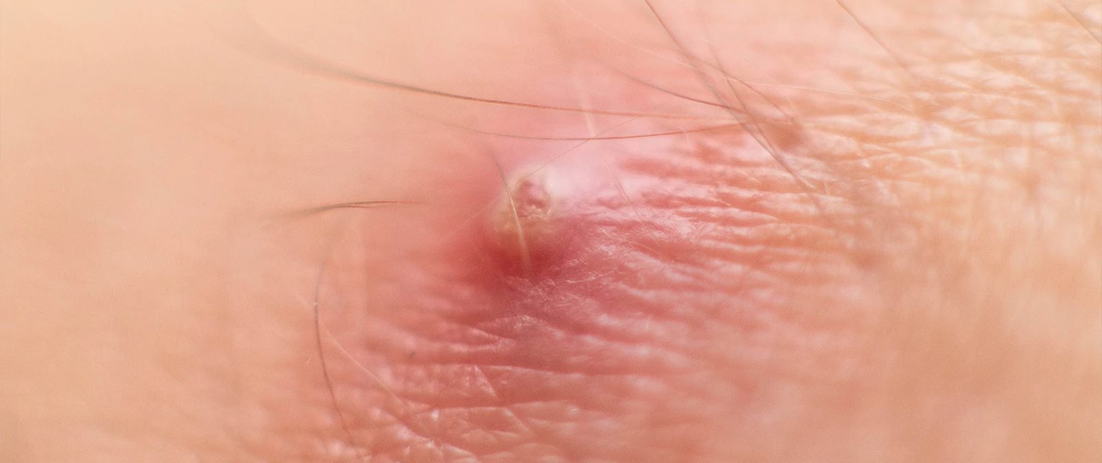 Perawatan bisul di kulit