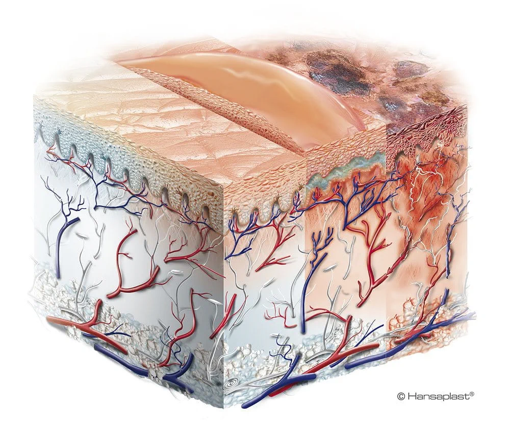 Scientific illustration of burn scarring