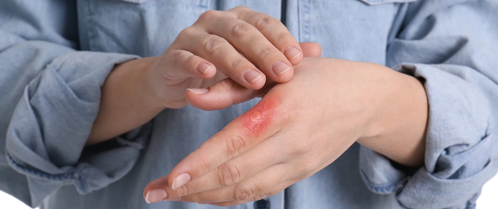 Tangan terkena air panas menimbulkan rasa nyeri