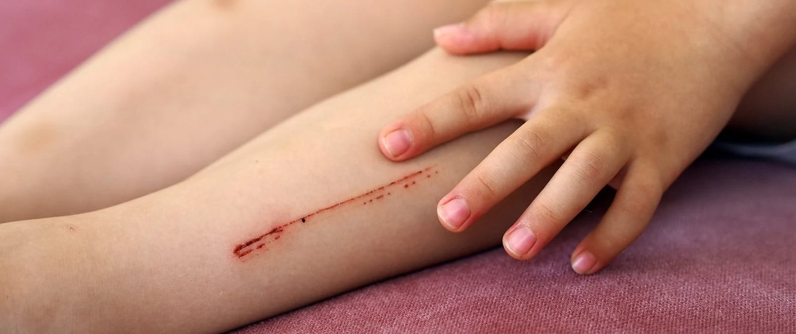 Cara mengatasi luka lecet dengan baik agar tidak menjadi luka serius.