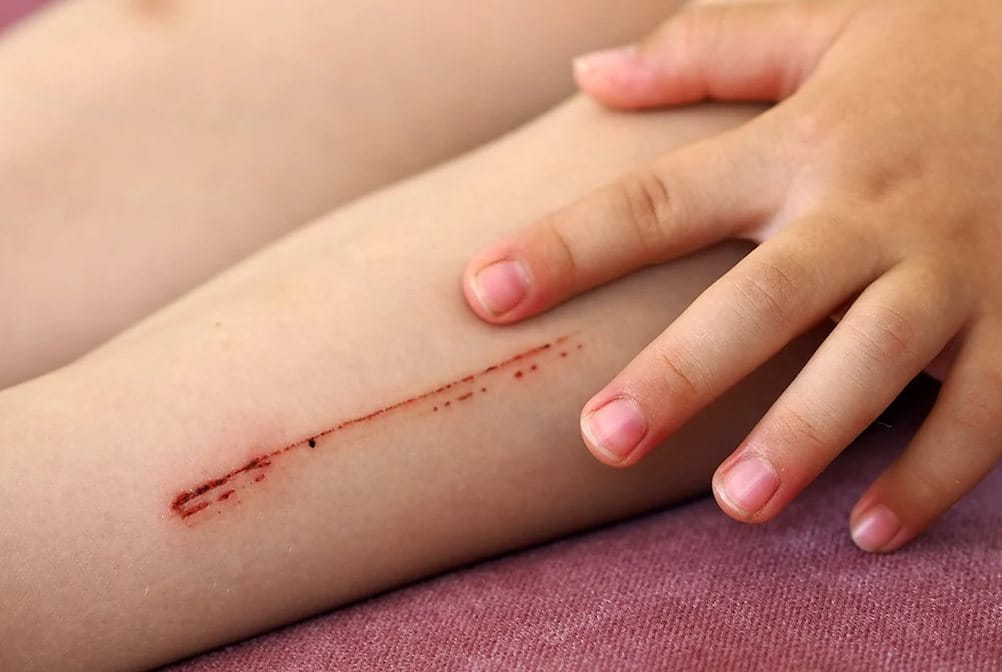 Cara mengatasi luka lecet dengan baik agar tidak menjadi luka serius.