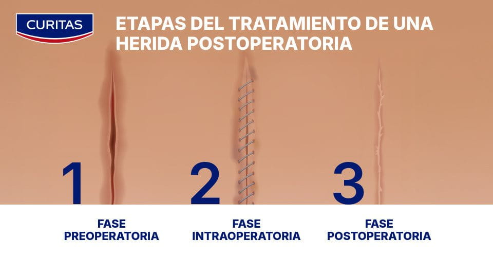 Tratamiento de una herida postoperatoria