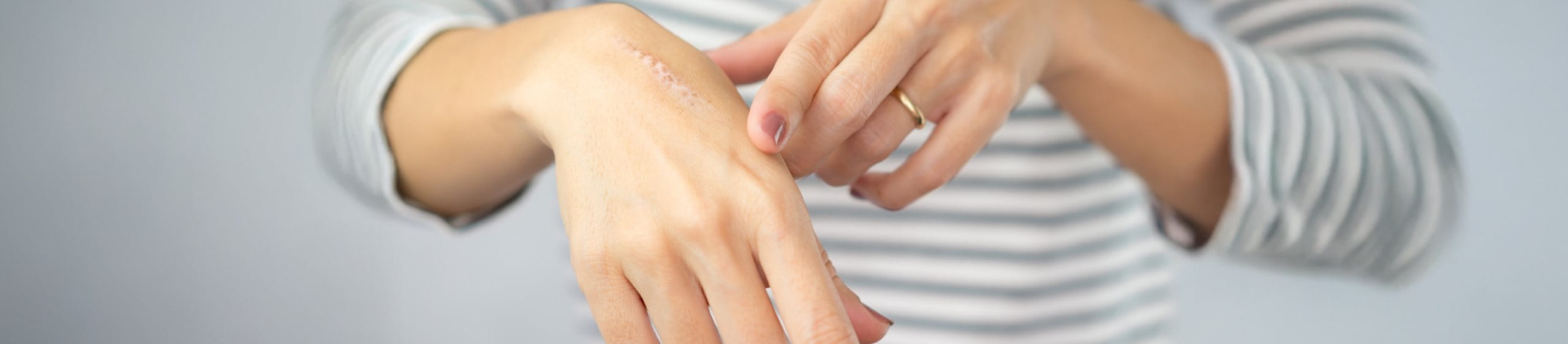 Tratamiento para cicatrices