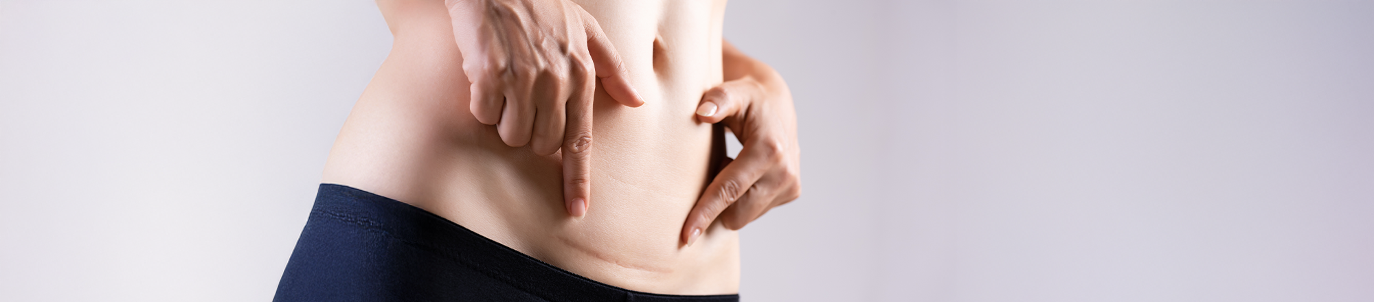 Nahaufnahme des Bauchs einer Frau. Zwei Hände zeigen mit ihren Zeigefingern auf eine deutlich sichtbare Kaiserschnittnarbe.