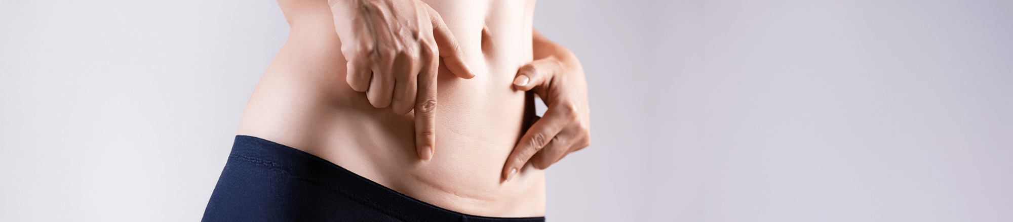 Nahaufnahme des Bauchs einer Frau. Zwei Hände zeigen mit ihren Zeigefingern auf eine deutlich sichtbare Kaiserschnittnarbe.