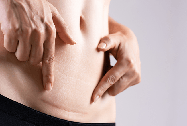 Nahaufnahme des Bauchs einer Frau. Zwei Hände zeigen mit ihren Zeigefingern auf eine deutlich sichtbare Kaiserschnittnarbe.