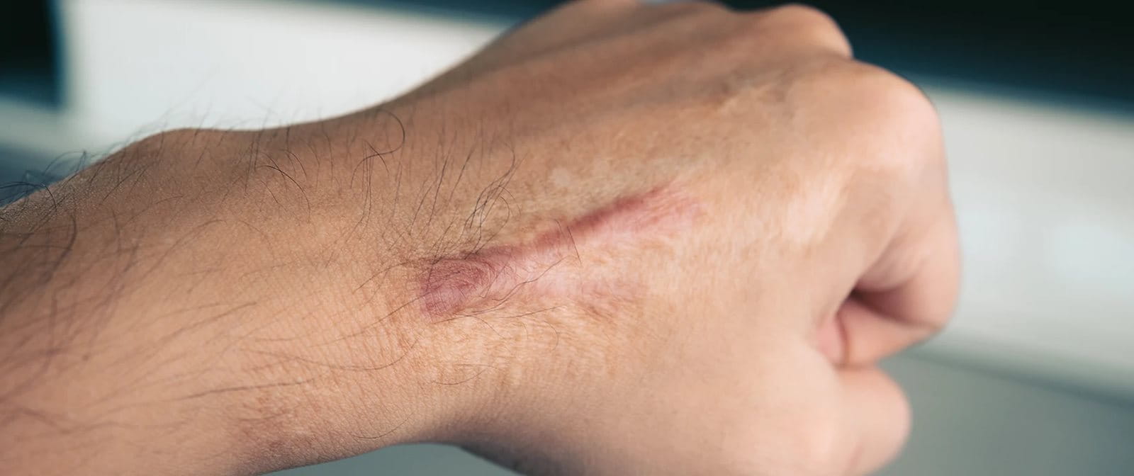 Bekas luka yang bisa tertinggal setelah operasi atau cedera.