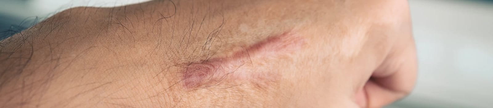 Bekas luka yang bisa tertinggal setelah operasi atau cedera.