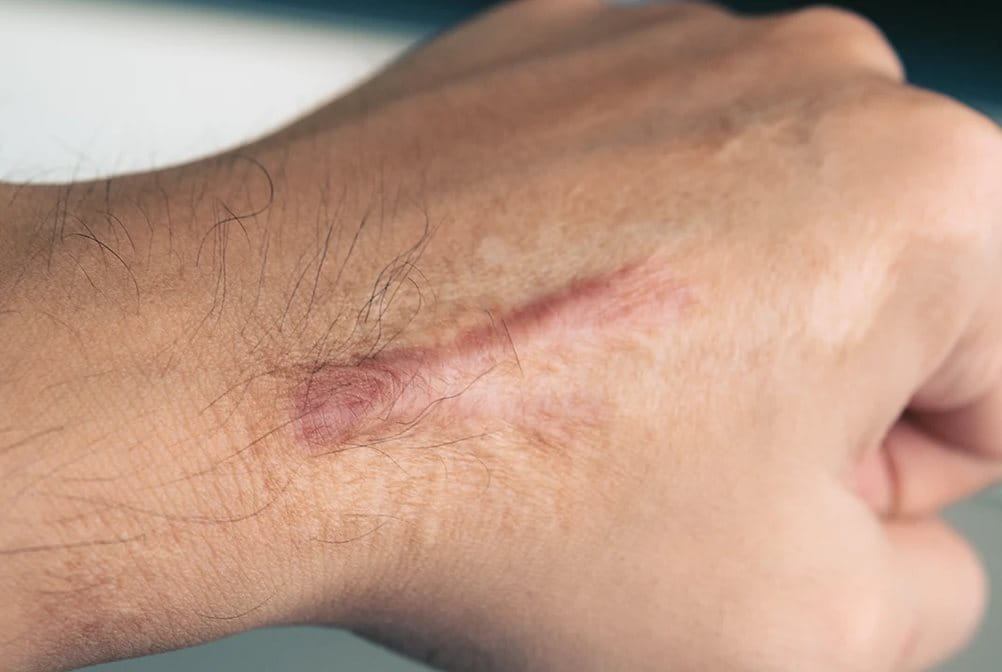 Bekas luka yang bisa tertinggal setelah operasi atau cedera.