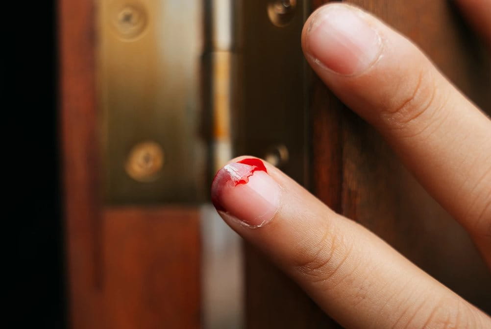 Cara menangani jari kejepit pintu.