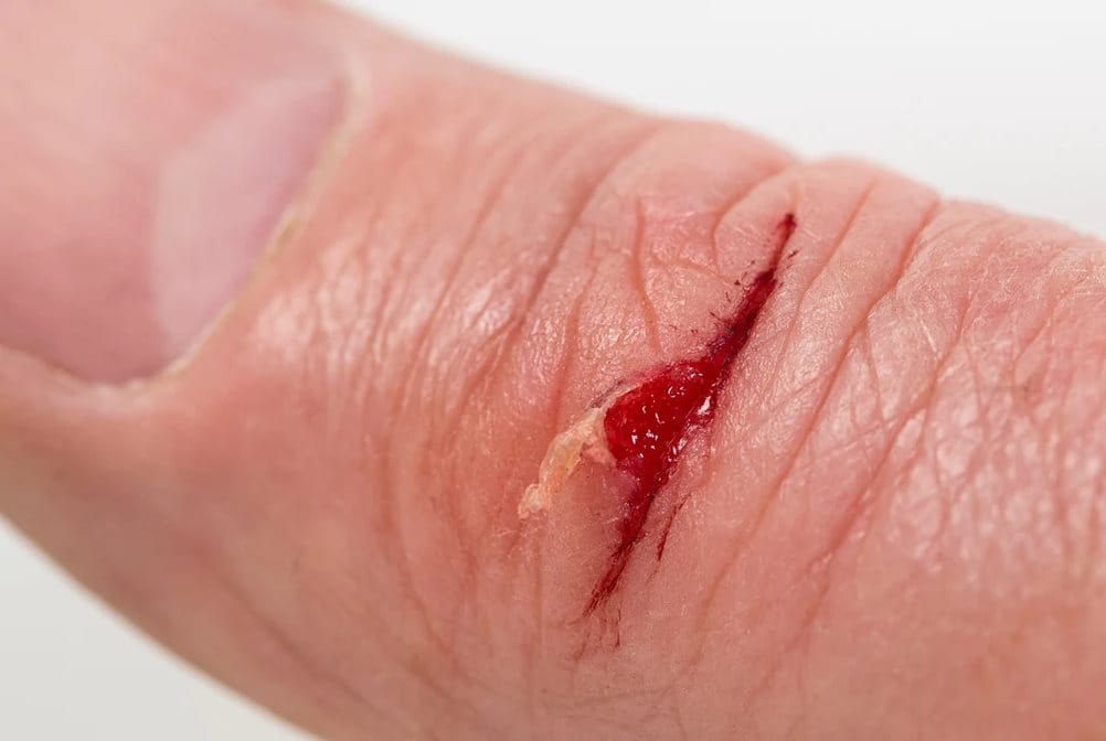 luka baret di tangan