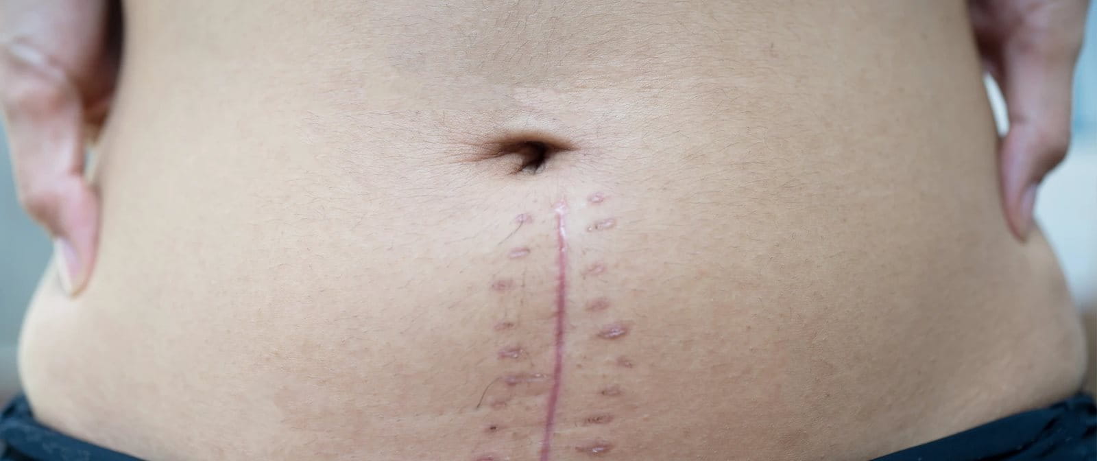 Jahitan bekas luka operasi