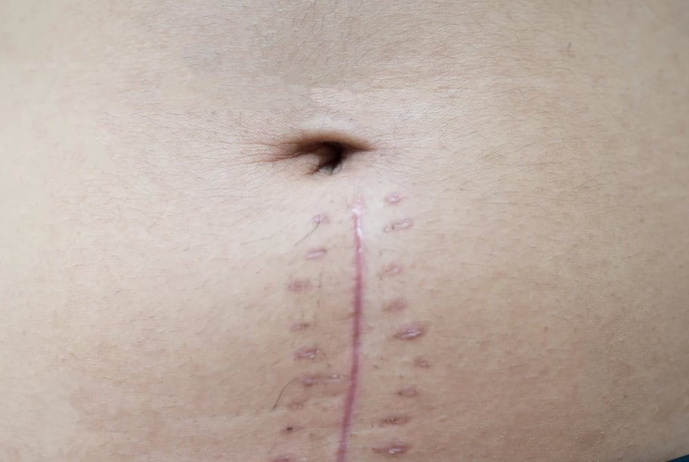 Jahitan bekas luka operasi